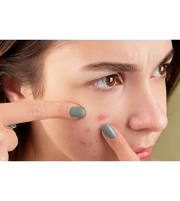 Purging vs. pattanások: milyen a bőrtisztulás folyamata?