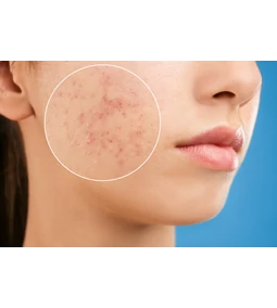 Az aknés, zsíros bőr mindennapi ápolása